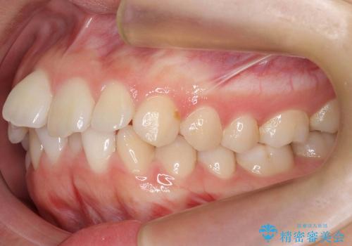出っ歯　下の前歯が生まれつき少ないの治療前