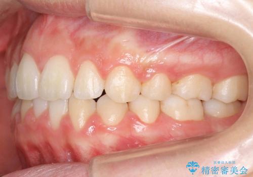 出っ歯　下の前歯が生まれつき少ないの治療後