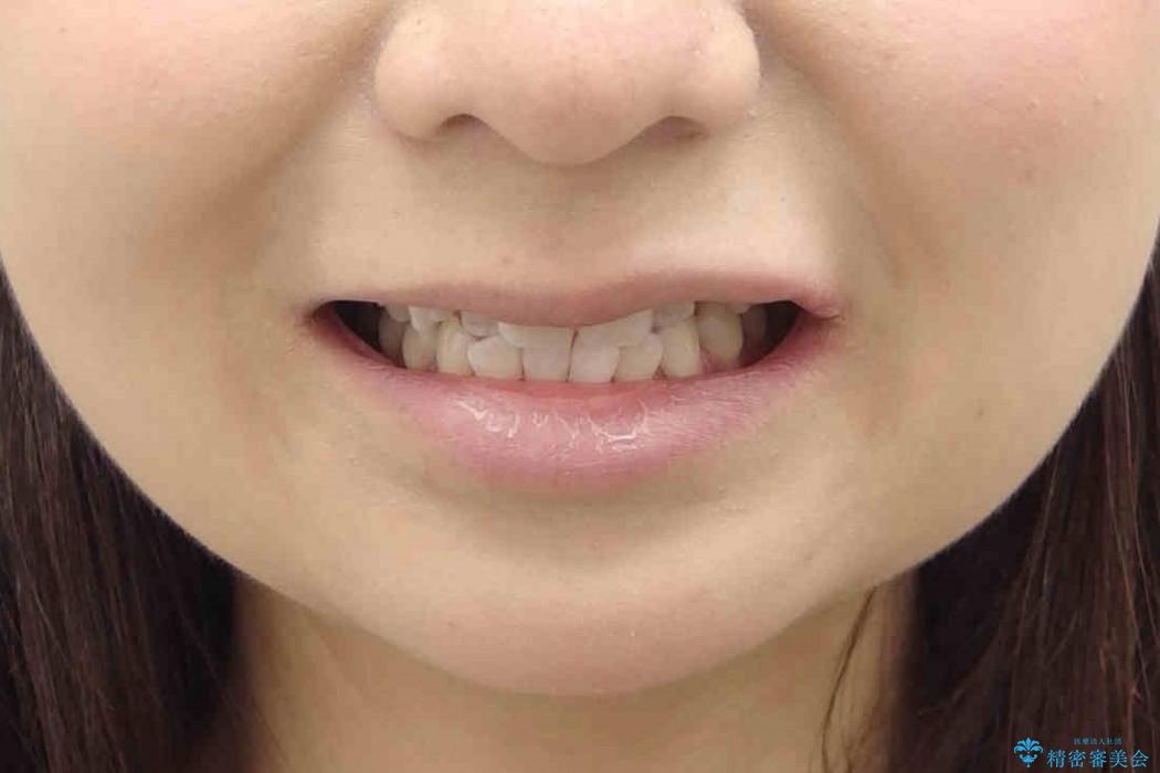 [20代女性]上の八重歯　咬みあわせのずれの治療前（顔貌）