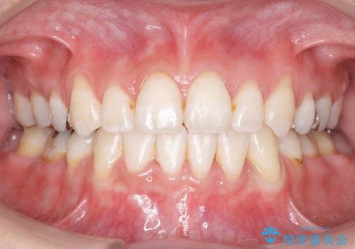 [20代女性]上の八重歯　咬みあわせのずれの治療後