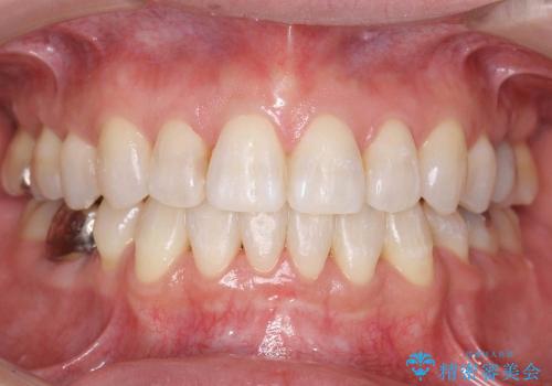 天然歯を残す矯正の治療後