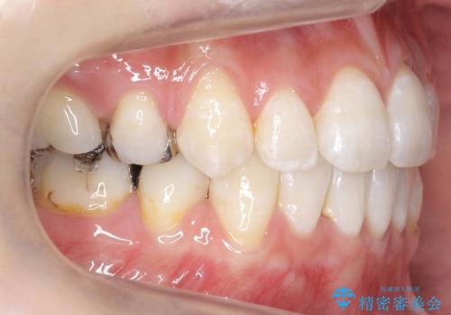 [20代女性]上の八重歯　咬みあわせのずれの治療後