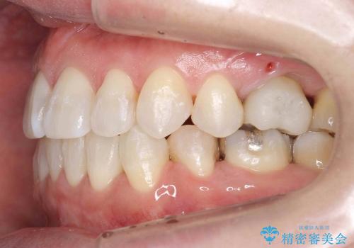 天然歯を残す矯正の治療後