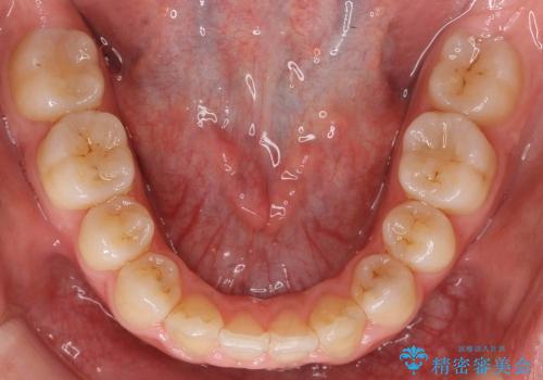 出っ歯　下の前歯が生まれつき少ないの治療後
