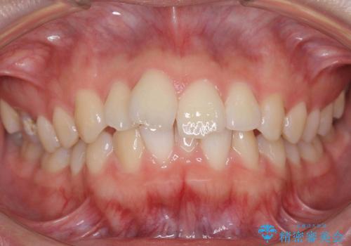 出っ歯　下の前歯が生まれつき少ないの治療前
