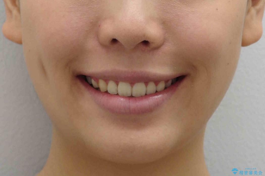 出っ歯　下の前歯が生まれつき少ないの治療後（顔貌）