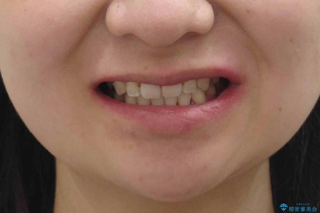 [20代女性]上の八重歯　咬みあわせのずれの治療後（顔貌）