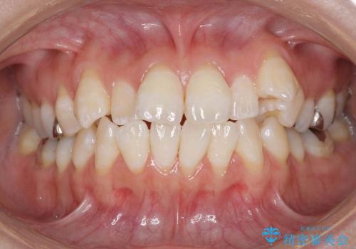[20代女性]上の八重歯　咬みあわせのずれの治療前