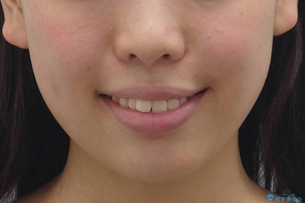 出っ歯　下の前歯が生まれつき少ないの治療前（顔貌）