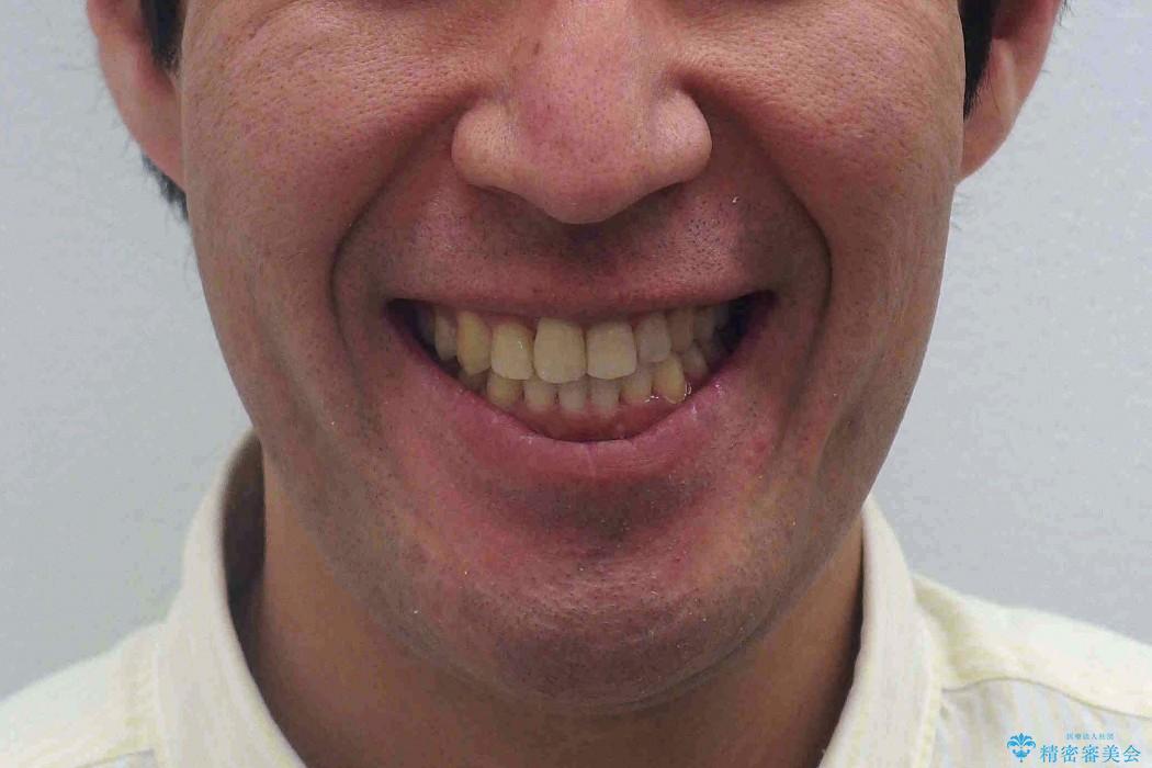 骨格性の受け口　顎の手術を回避の治療後（顔貌）