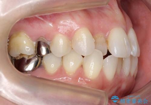 天然歯を残す矯正の治療前