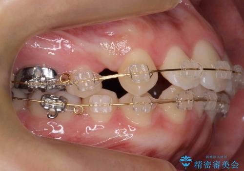 出っ歯　下の前歯が生まれつき少ないの治療中