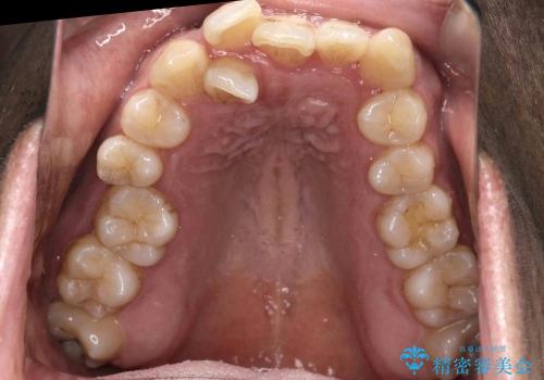骨格性の受け口　顎の手術を回避の治療前