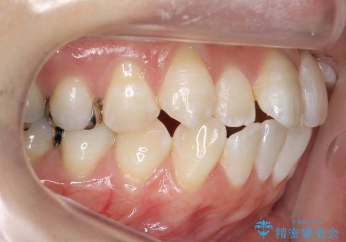 [20代女性]上の八重歯　咬みあわせのずれの治療前