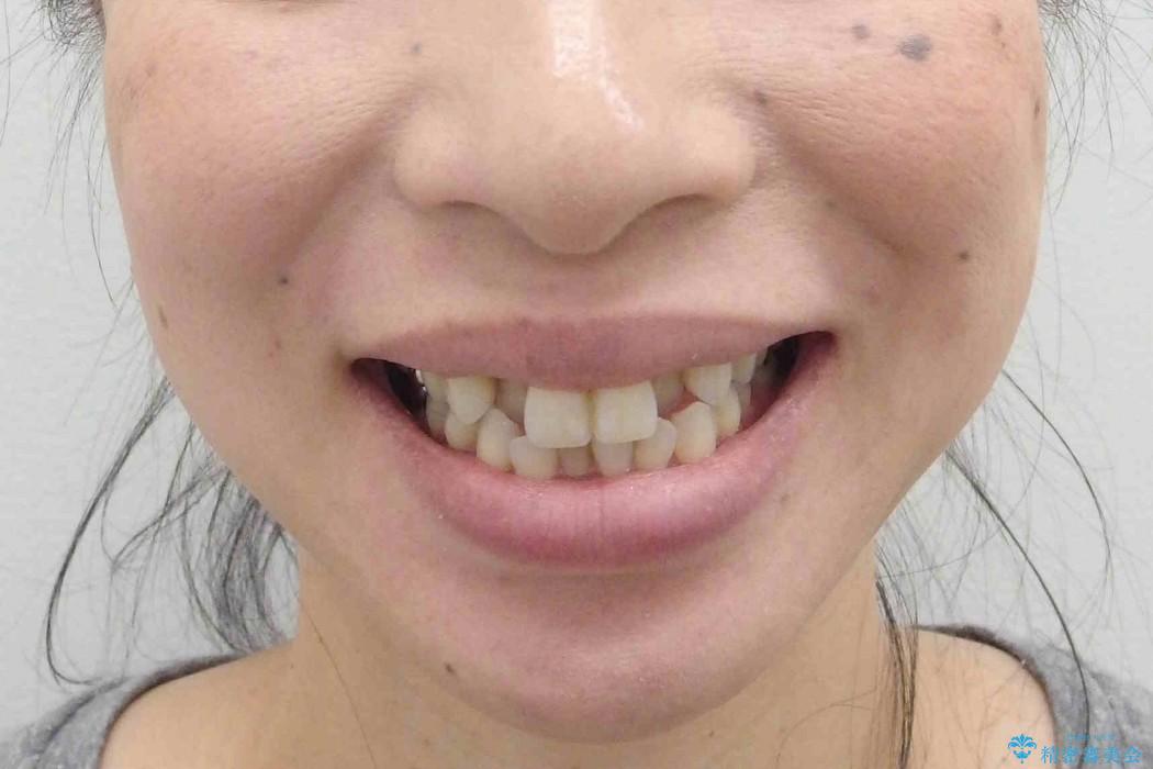 天然歯を残す矯正の治療前（顔貌）