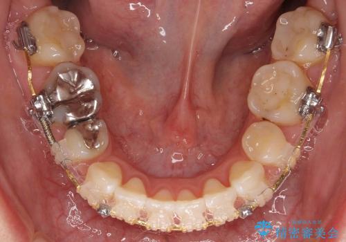 [20代女性]上の八重歯　咬みあわせのずれの治療中