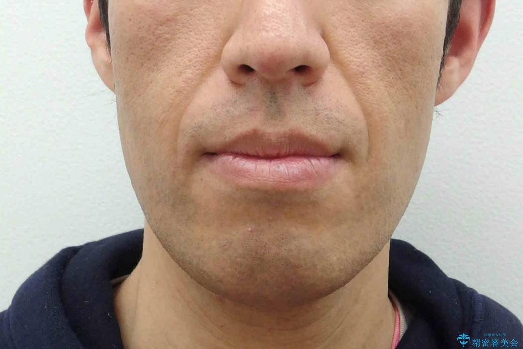 骨格性の受け口　顎の手術を回避の治療前（顔貌）