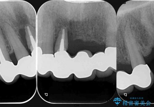 [顎堤増大]  歯肉移植を行い審美性を回復した前歯ブリッジ治療の治療前