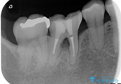 [根分岐部病変Ⅲ度]  悪化する奥歯の歯周病　インプラントを用いた治療の治療前