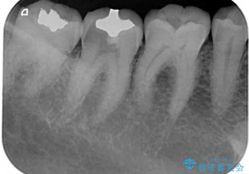歯肉の中まで歯が欠けて痛いの治療前