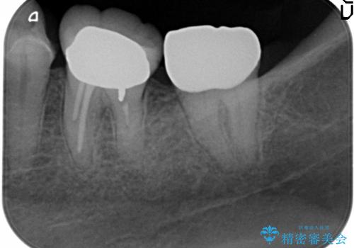 40代女性　高さの無い歯の再修復はの治療後