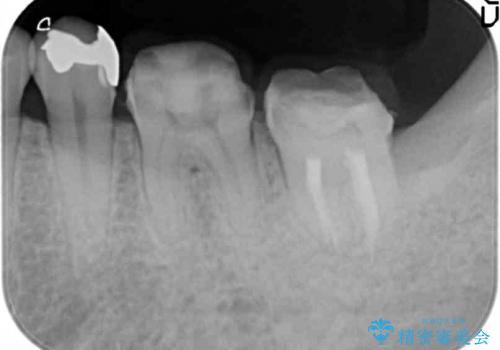 奥歯の違和感　神経がない歯のう蝕　30代男性の治療中