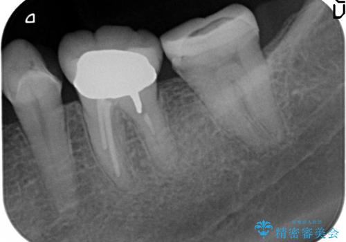 40代女性　高さの無い歯の再修復はの治療前