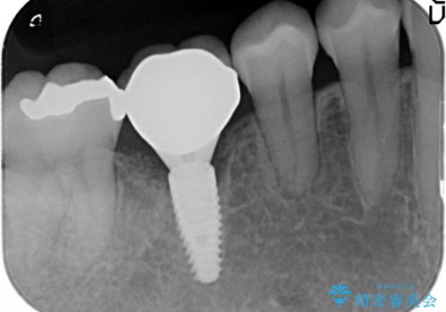 [根分岐部病変Ⅲ度]  悪化する奥歯の歯周病　インプラントを用いた治療の治療後