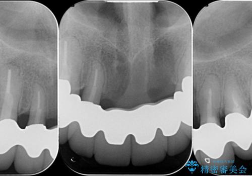 [前歯の審美・機能回復] 前歯を複数本失った場合 3つの治療方法の治療後