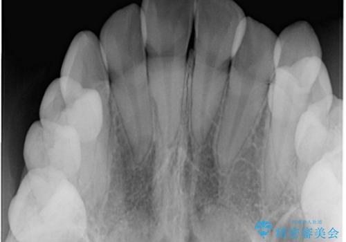 上顎の骨を拡大　非抜歯による八重歯の矯正治療の治療前