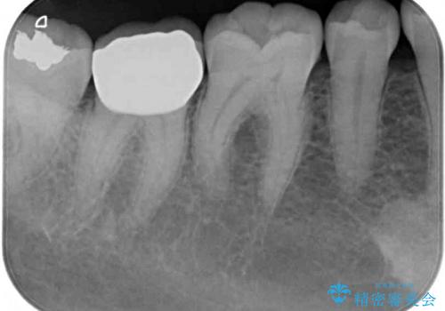 歯肉の中まで歯が欠けて痛いの治療後