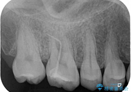 上顎大臼歯にはゴールドクラウンがおすすめの治療前