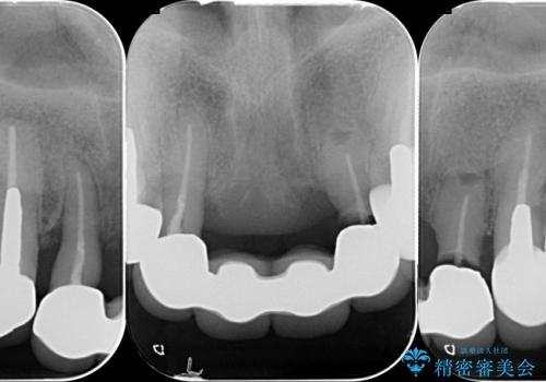 [前歯の審美・機能回復] 前歯を複数本失った場合 3つの治療方法の治療前