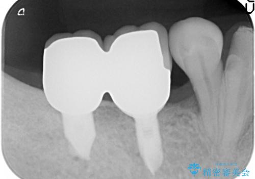 [重度歯周病] 骨造成を伴うインプラント咬合機能回復治療の治療後