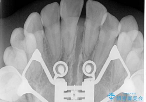 上顎の骨を拡大　非抜歯による八重歯の矯正治療の治療中