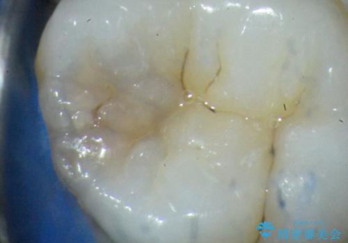 顕微鏡治療下で行う精密虫歯治療・セラミックインレー修復の治療前