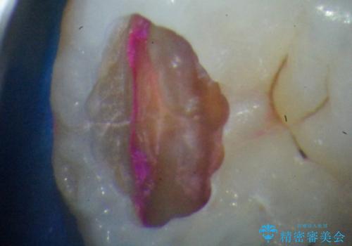顕微鏡治療下で行う精密虫歯治療・セラミックインレー修復の治療中