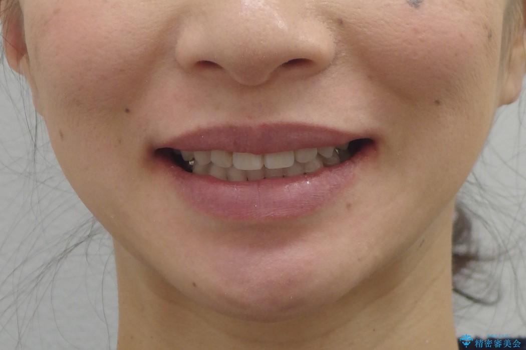 天然歯を残す矯正の治療後（顔貌）