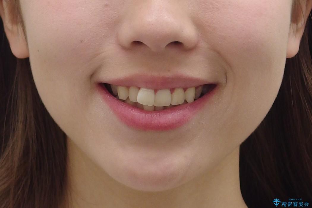 [20代女性]　前歯のねじれ　抜かない、見えない矯正の治療前（顔貌）