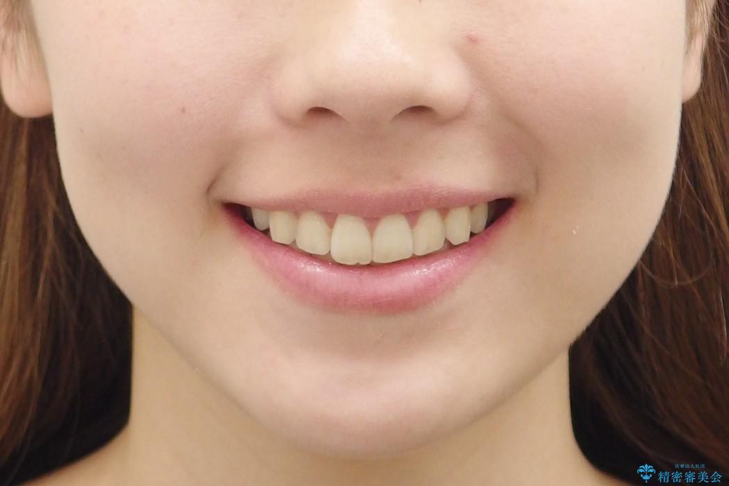 [20代女性]　前歯のねじれ　抜かない、見えない矯正の治療後（顔貌）