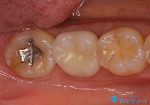歯肉の中まで歯が欠けて痛いの治療後