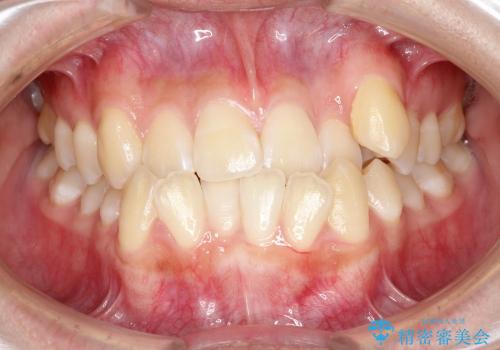 上顎の骨を拡大　非抜歯による八重歯の矯正治療