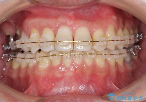 [歯ぐきの再生治療] 矯正治療前の歯ぐき移植の治療前