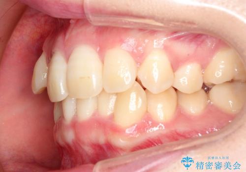 20代女性　八重歯の抜歯矯正の治療前