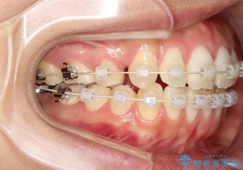 出っ歯　上顎前突の抜歯矯正の治療中