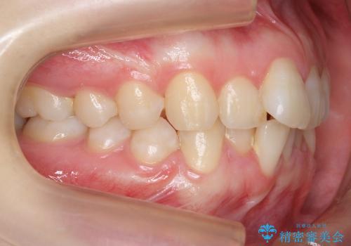 [20代女性]　前歯のねじれ　抜かない、見えない矯正の治療前