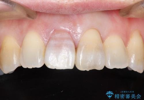 状況によっては　歯の変色もホワイトニングで白くできるの治療前