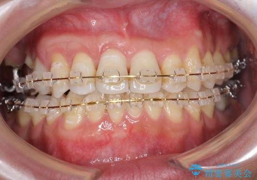 [歯ぐきの再生治療] 矯正治療前の歯ぐき移植の治療前