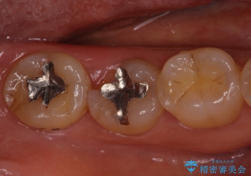 歯肉の中まで歯が欠けて痛いの治療前