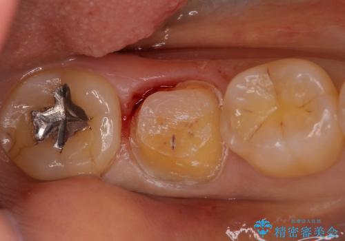 歯肉の中まで歯が欠けて痛いの治療中